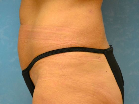 Liposuction: Case 1529- Monclova, OH - After