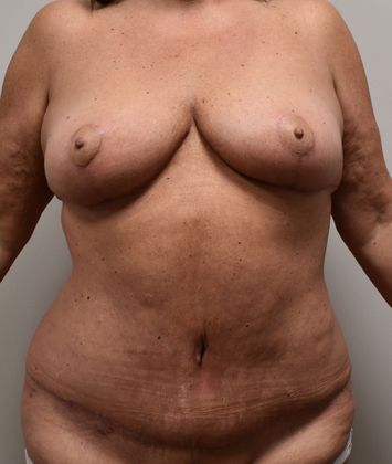 Massive Weight Loss : Case 57 - After