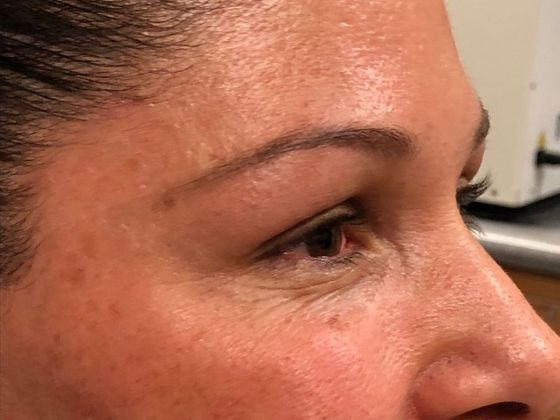 BOTOX® Cosmetic*: Case 3 - After