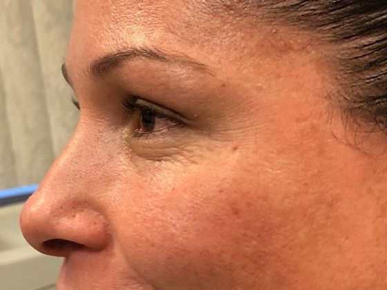 BOTOX® Cosmetic*: Case 3 - After