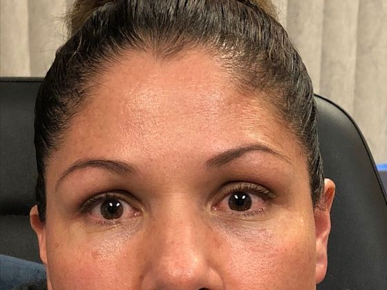 BOTOX® Cosmetic*: Case 3 - After