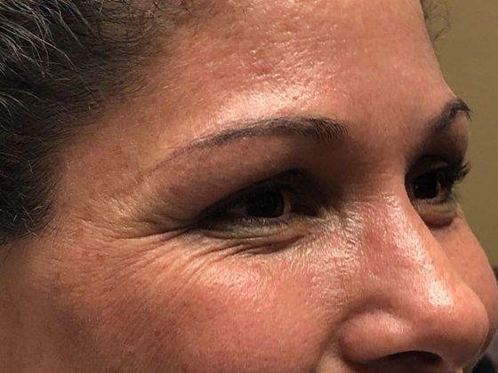 BOTOX® Cosmetic*: Case 3 - Before