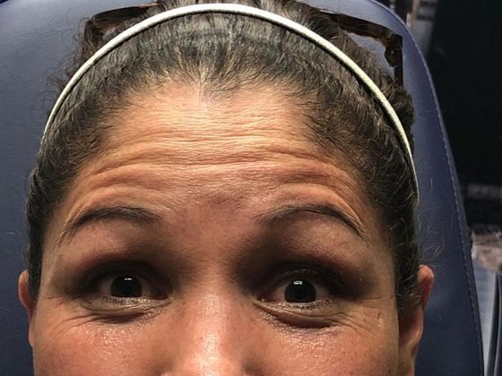 BOTOX® Cosmetic*: Case 3 - Before