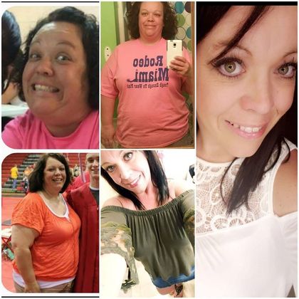 Gastric Sleeve - Click Here to See More! : Case 29 - Before & After