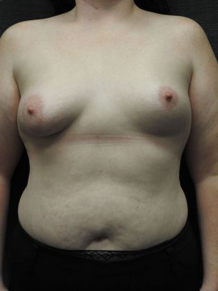 Breast Augmentation: Case 16 - San Antonio - Before
