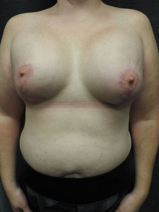 Breast Augmentation: Case 16 - San Antonio - After