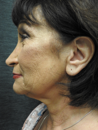 Facelift: Case 3 - San Antonio - Before