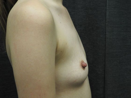 Breast Augmentation: Case 18 - San Antonio - Before