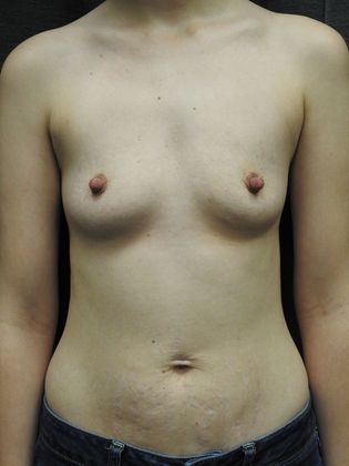 Breast Augmentation: Case 18 - San Antonio - Before
