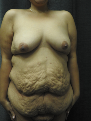 Breast Lift Case 19 - San Antonio - Before