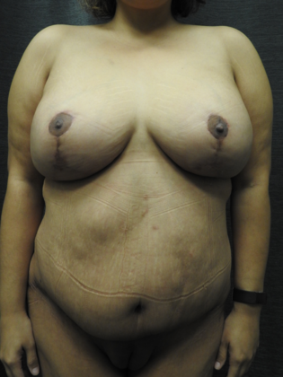 Breast Lift Case 19 - San Antonio - After