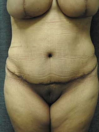 Abdominoplasty Case 12 - San Antonio - After