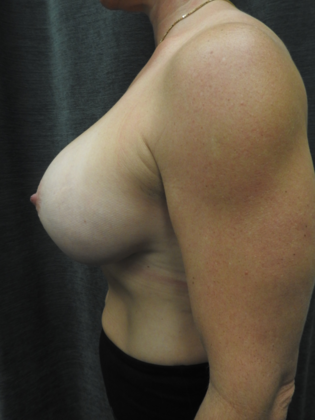 Breast Augmentation: Case 21 - San Antonio - After