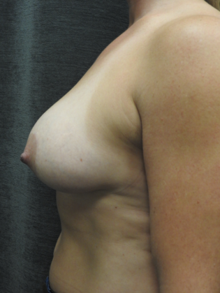 Breast Augmentation: Case 21 - San Antonio - Before
