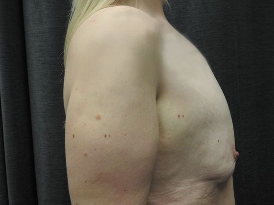 Breast Augmentation: Case 24 - San Antonio - Before