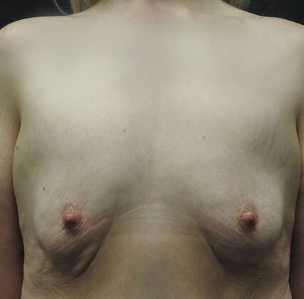 Breast Augmentation: Case 24 - San Antonio - Before