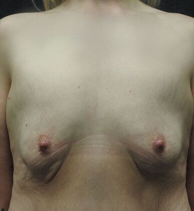 Breast Lift Case 22 - San Antonio - Before