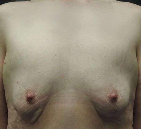 Ideal Implant Case 18 - San Antonio - Before