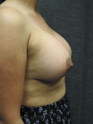 Breast Augmentation: Case 25 - San Antonio - After