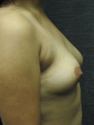 Breast Augmentation: Case 25 - San Antonio - Before