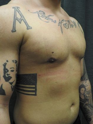 Breast Reduction: Case 4 - San Antonio - After