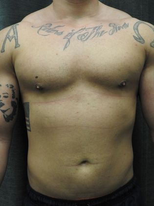 Breast Reduction: Case 4 - San Antonio - After