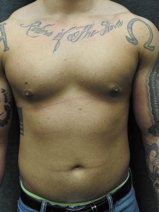 Breast Reduction: Case 4 - San Antonio - Before