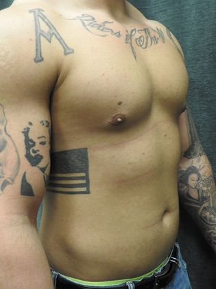 Breast Reduction: Case 4 - San Antonio - Before