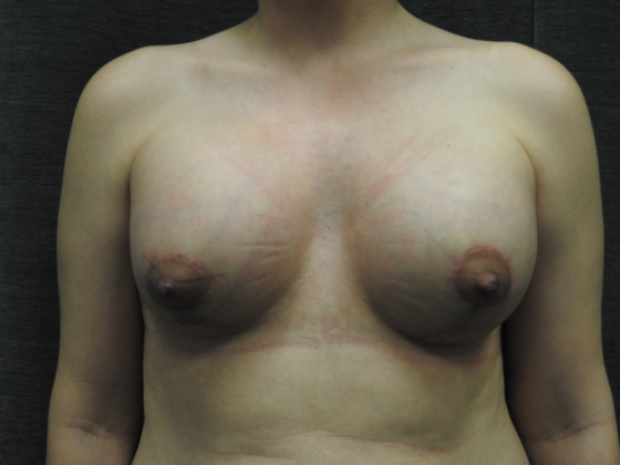 Breast Augmentation: Case 27 - San Antonio - After