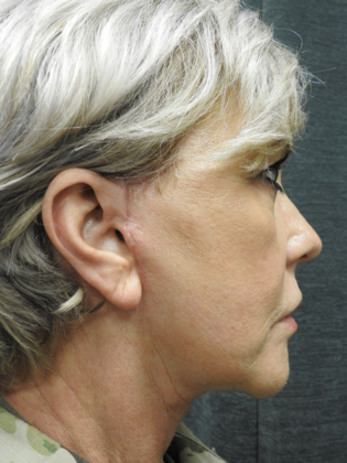 Facelift: Case 4 - San Antonio - After