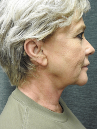 Facelift: Case 4 - San Antonio - Before