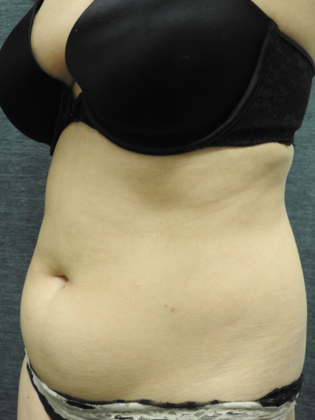 Laser Liposuction: Case 2 - San Antonio - Before