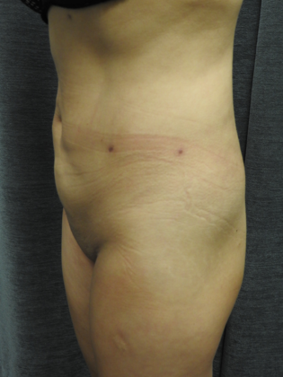 Laser Liposuction: Case 2 - San Antonio - After
