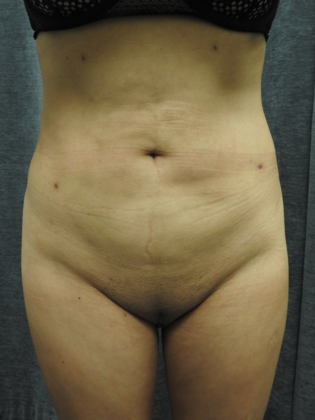 Laser Liposuction Case 2 - San Antonio - After