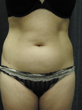Laser Liposuction Case 2 - San Antonio - Before
