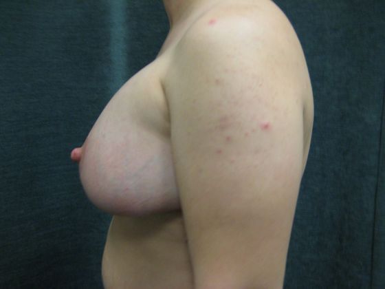 Breast Augmentation: Case 28 - San Antonio - After