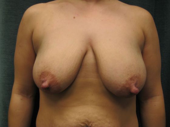Breast Lift Case 24 - San Antonio - Before