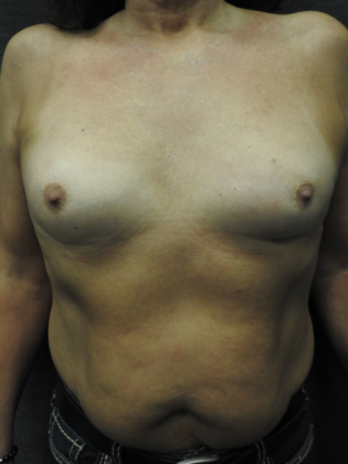 Ideal Implant Case 22 - San Antonio - Before