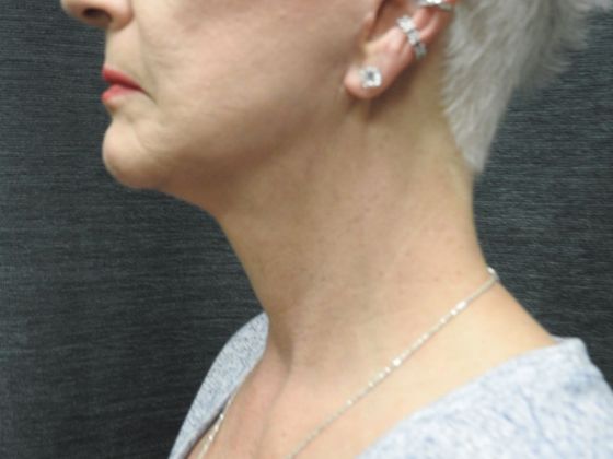 Facelift: Case 5 - San Antonio - After