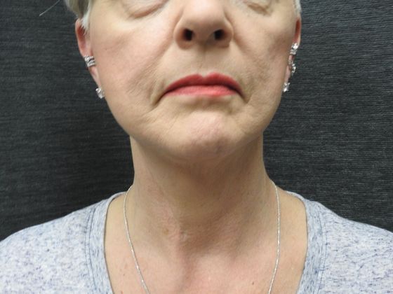 Facelift: Case 5 - San Antonio - After