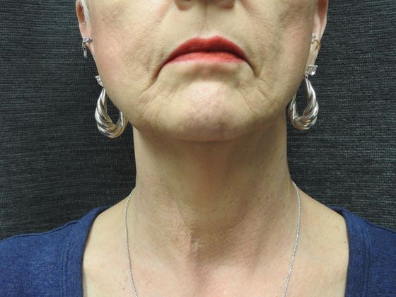 Facelift: Case 5 - San Antonio - Before