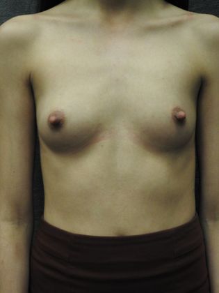 Breast Lift Case 25 - San Antonio - Before
