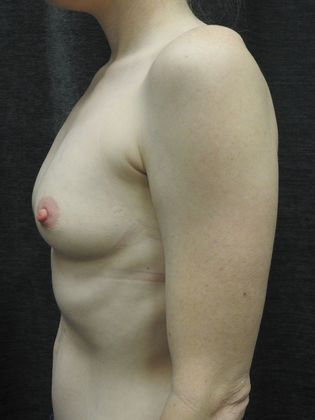 Ideal Implant: Case 23 - San Antonio - Before