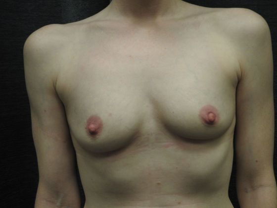 Ideal Implant Case 23 - San Antonio - Before