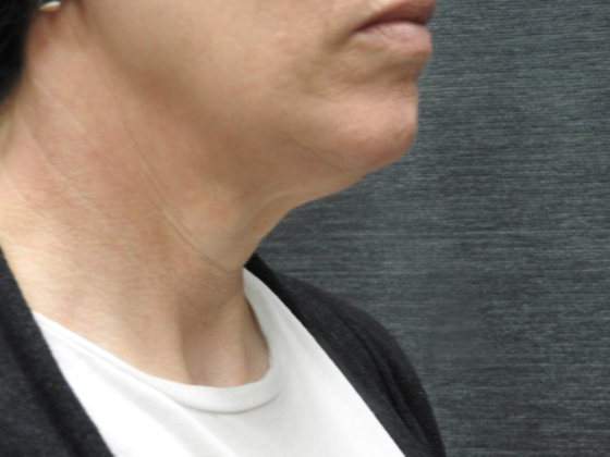 Facelift: Case 7 - San Antonio - Before