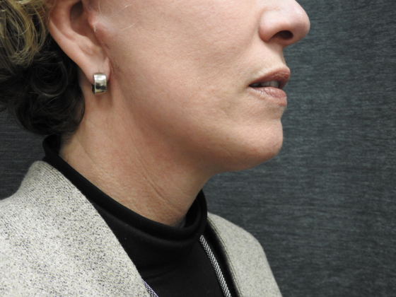 Facelift: Case 7 - San Antonio - After