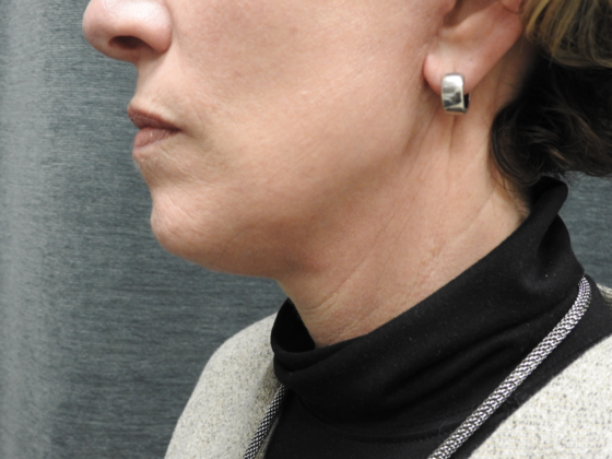 Facelift: Case 7 - San Antonio - After