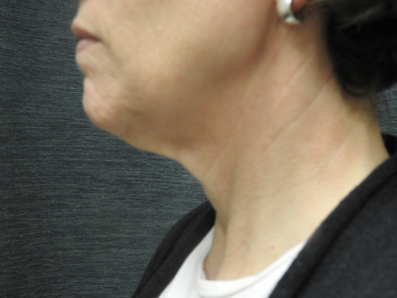 Cosmetic Injectables & Fillers Case 2 - San Antonio - Before