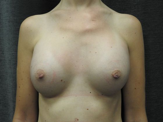 Breast Augmentation: Case 32 - San Antonio - After