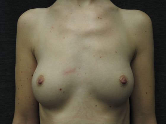 Breast Augmentation: Case 32 - San Antonio - Before